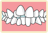 上顎前突（出っ歯）