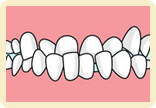 反対咬合（受け口）